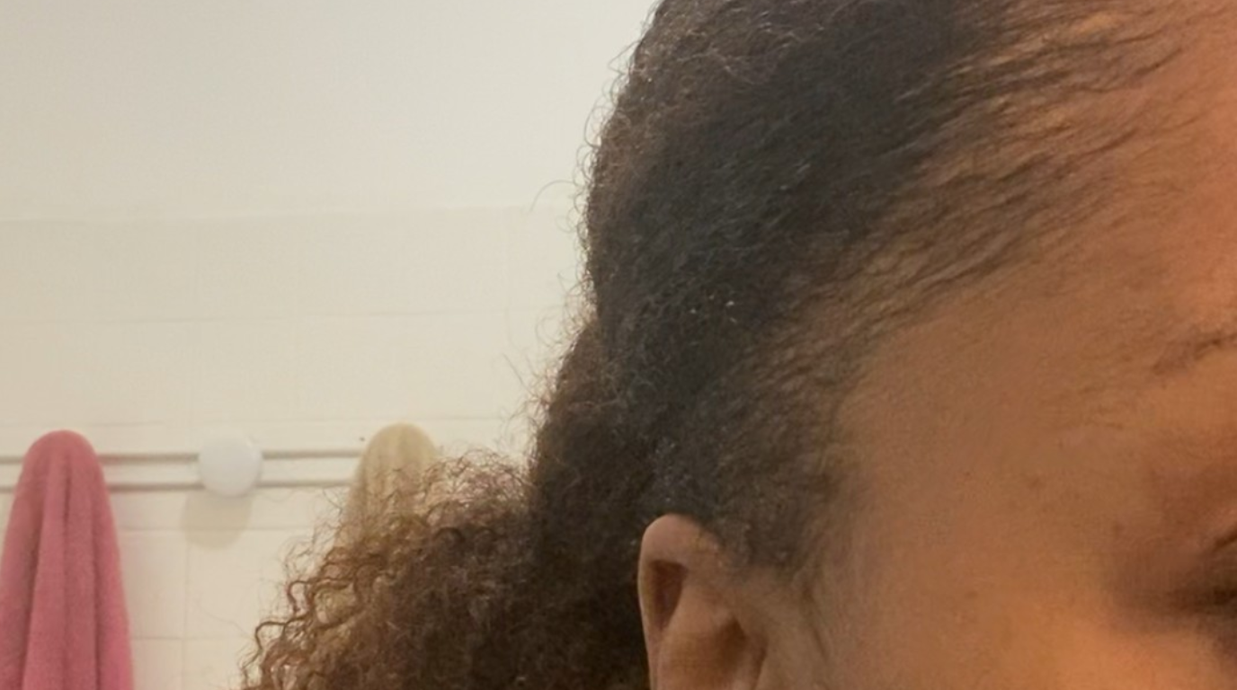 Alopécie et cheveux crépus : Comprendre les causes pour mieux les traiter.