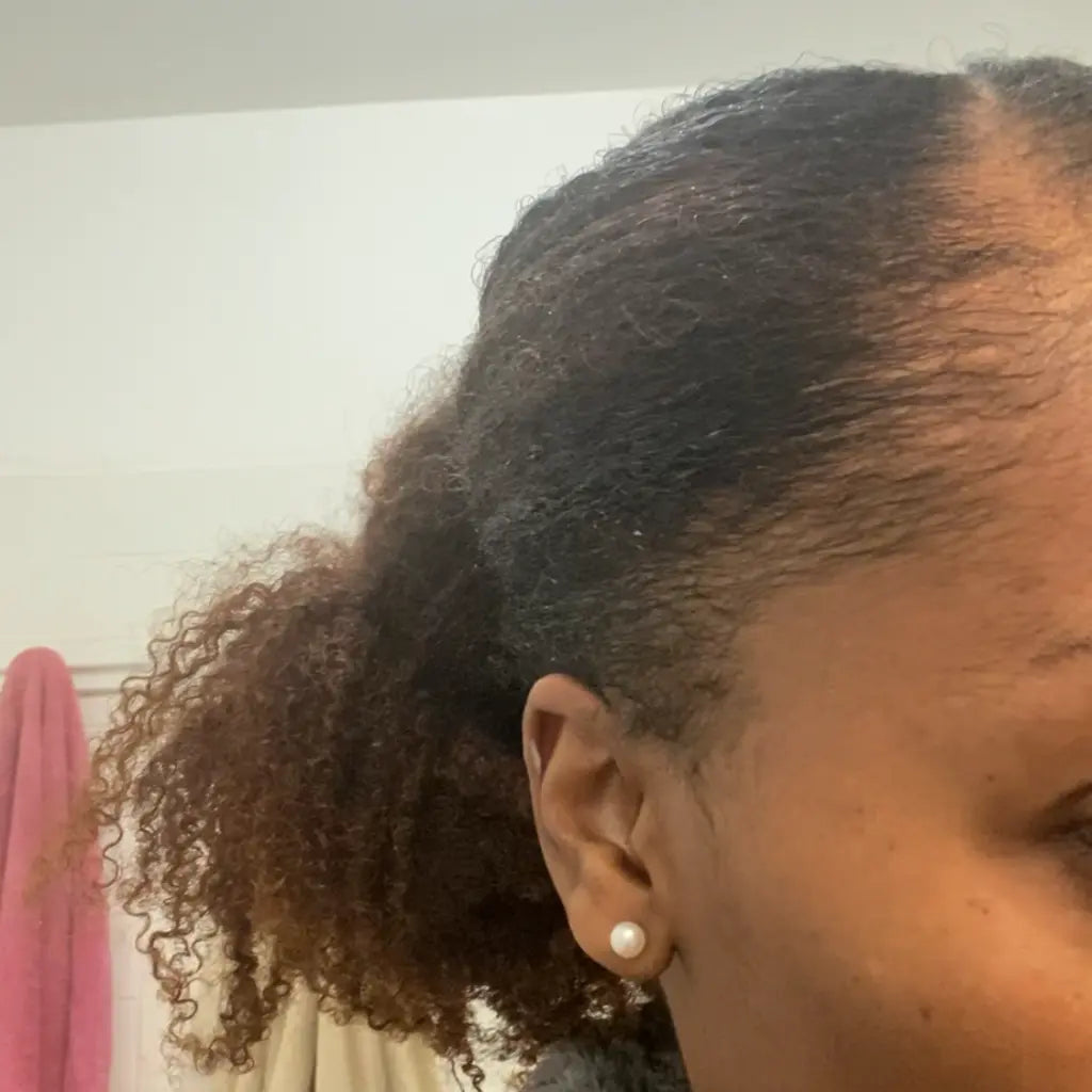 Alopécie et cheveux crépus : Comprendre les causes pour mieux les traiter.