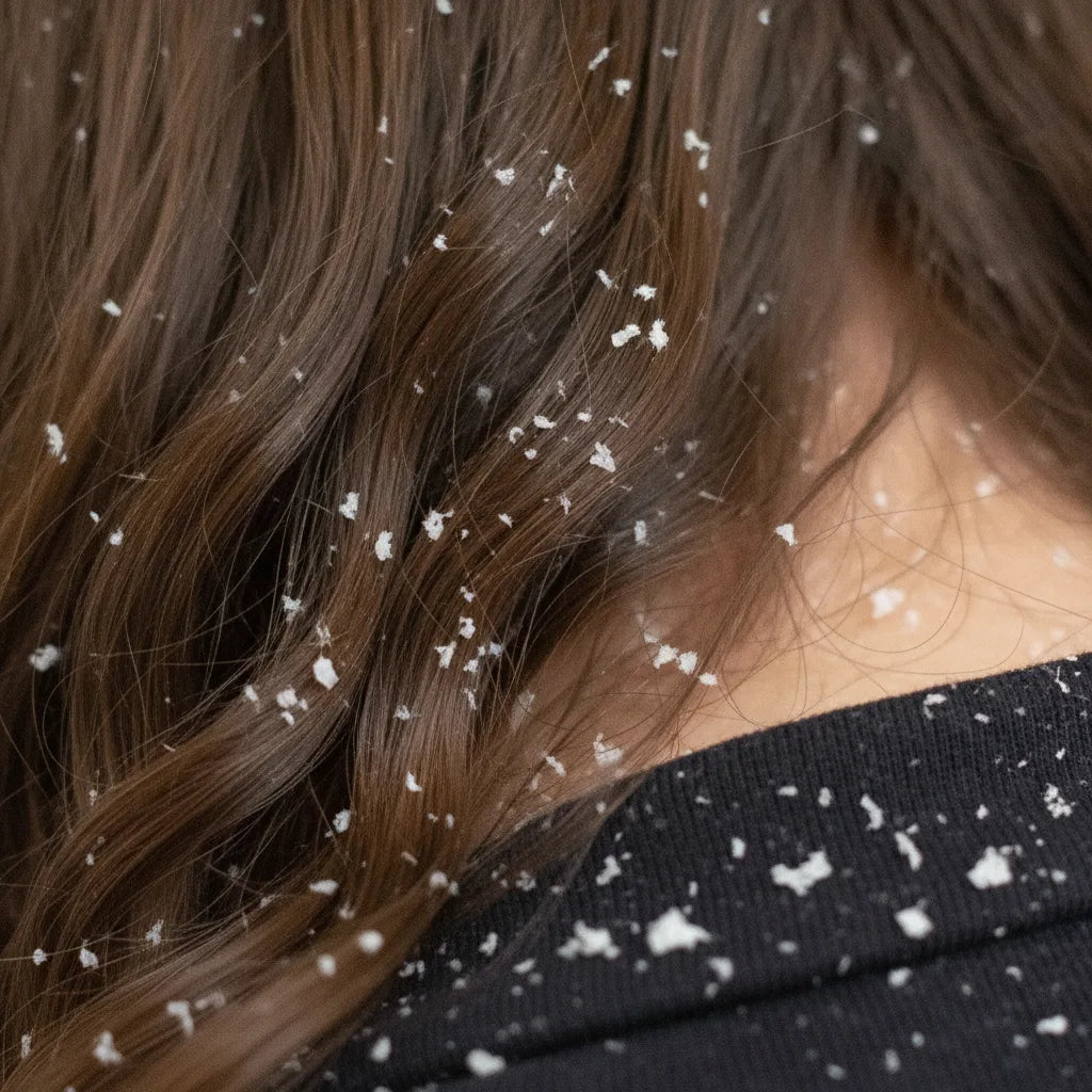 Cuir chevelu qui gratte et pellicules – Distinguer et traiter