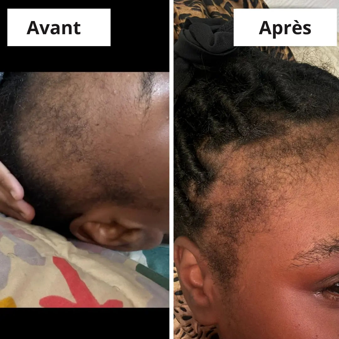 Sérum Mc Oil sur le cuir chevelu pour fortifier la racine